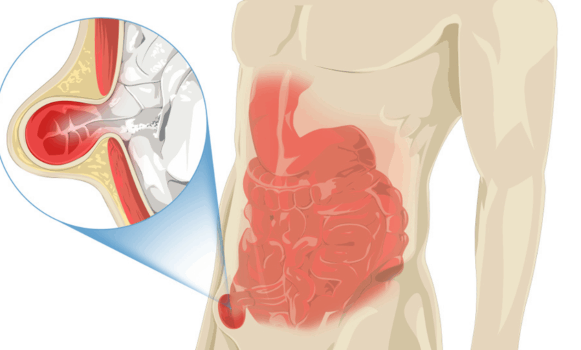 Βουβωνοκήλη