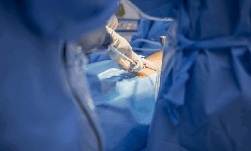 Λαπαροσκοπική χειρουργική