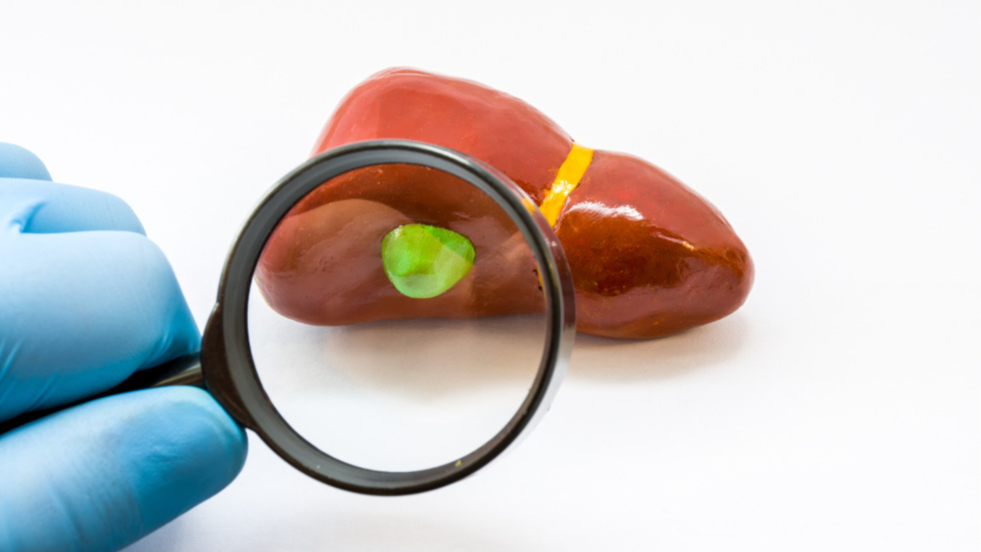 χολολιθίαση, Χολολιθίαση, Δρ. Δαρδαμάνης Δημήτριος