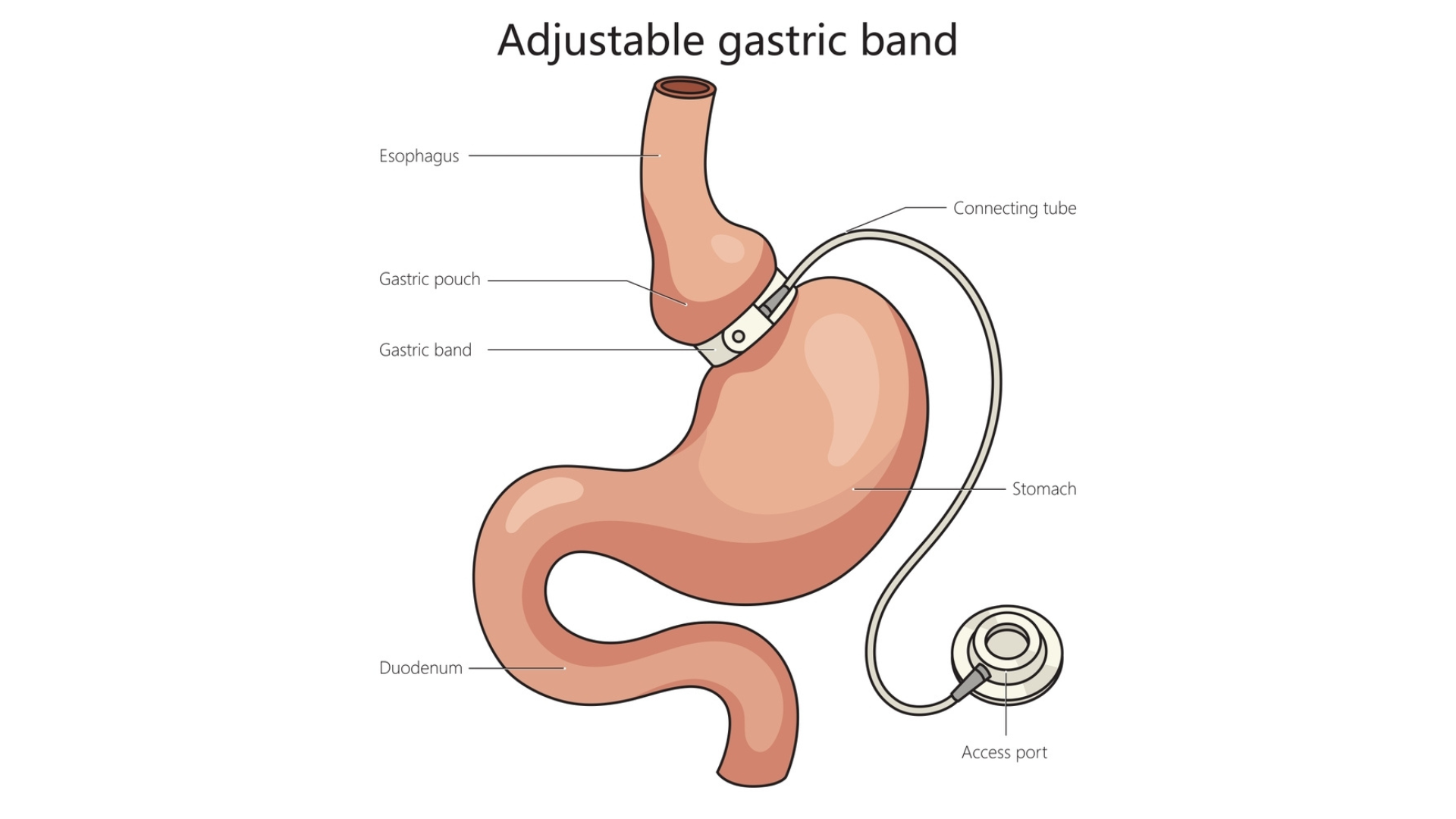 &alpha;&phi;&alpha;ί&rho;&epsilon;&sigma;&eta; &gamma;&alpha;&sigma;&tau;&rho;&iota;&kappa;&omicron;ύ &delta;&alpha;&kappa;&tau;&upsilon;&lambda;ί&omicron;&upsilon;, &Alpha;&phi;&alpha;ί&rho;&epsilon;&sigma;&eta; &gamma;&alpha;&sigma;&tau;&rho;&iota;&kappa;&omicron;ύ &delta;&alpha;&kappa;&tau;&upsilon;&lambda;ί&omicron;&upsilon;, &Delta;&rho;. &Delta;&alpha;&rho;&delta;&alpha;&mu;ά&nu;&eta;&sigmaf; &Delta;&eta;&mu;ή&tau;&rho;&iota;&omicron;&sigmaf;